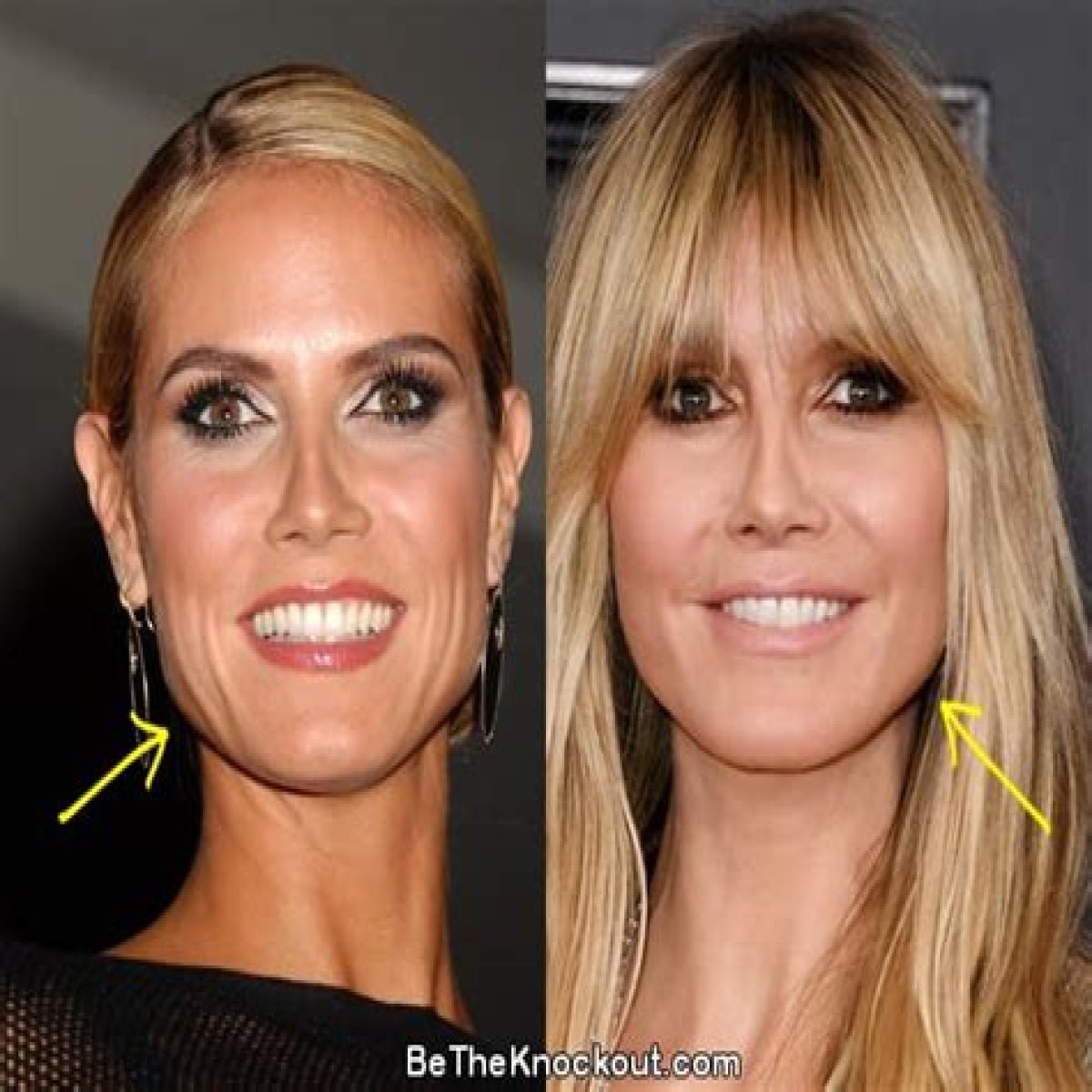 Heidi Klum: plastic surgery “doesn’t look pretty,   especially on young girls”