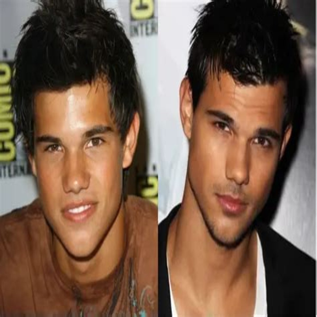 Taylor Lautner Plastic Surgery Before and After